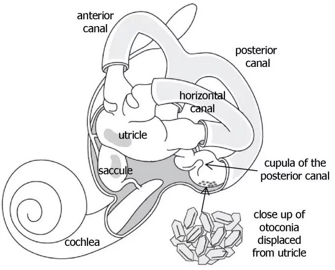 Understanding BPPV: The Most Common Vestibular Disorder - goPhysio